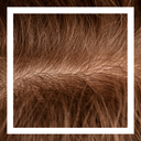 The Hidden Cause of Hair Loss: Follicle Miniaturization
