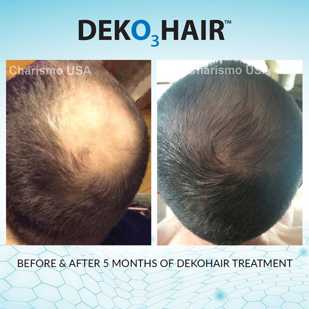 DEKOHAIR - 6 Months