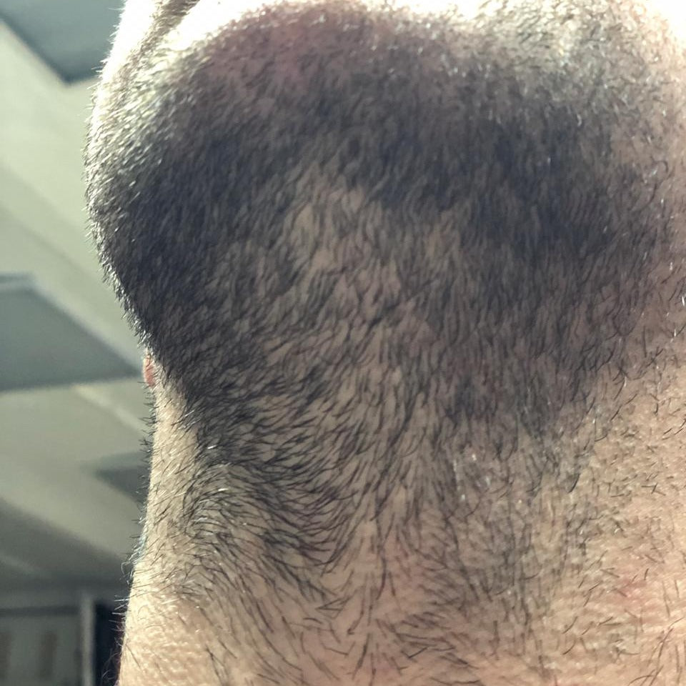 Underside of a beard before DEKOBEARD use