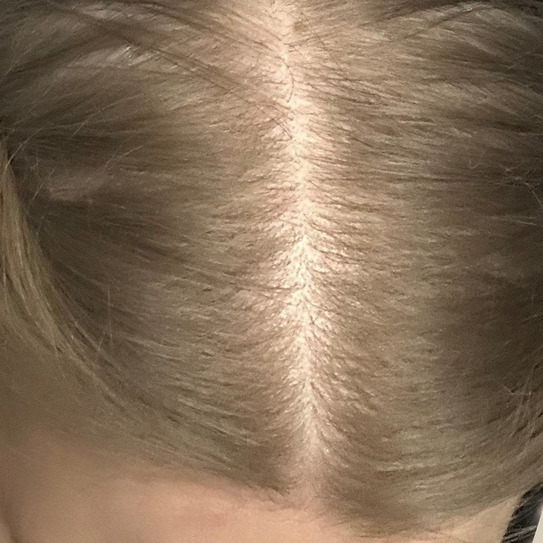 Part line of the same female scalp after five months of nightly DEKOHAIR use