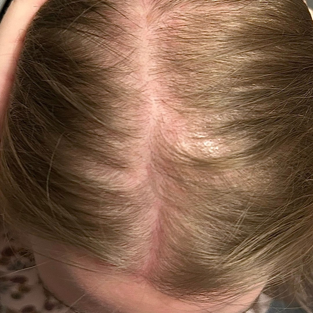 Part line of a female scalp before DEKOHAIR use