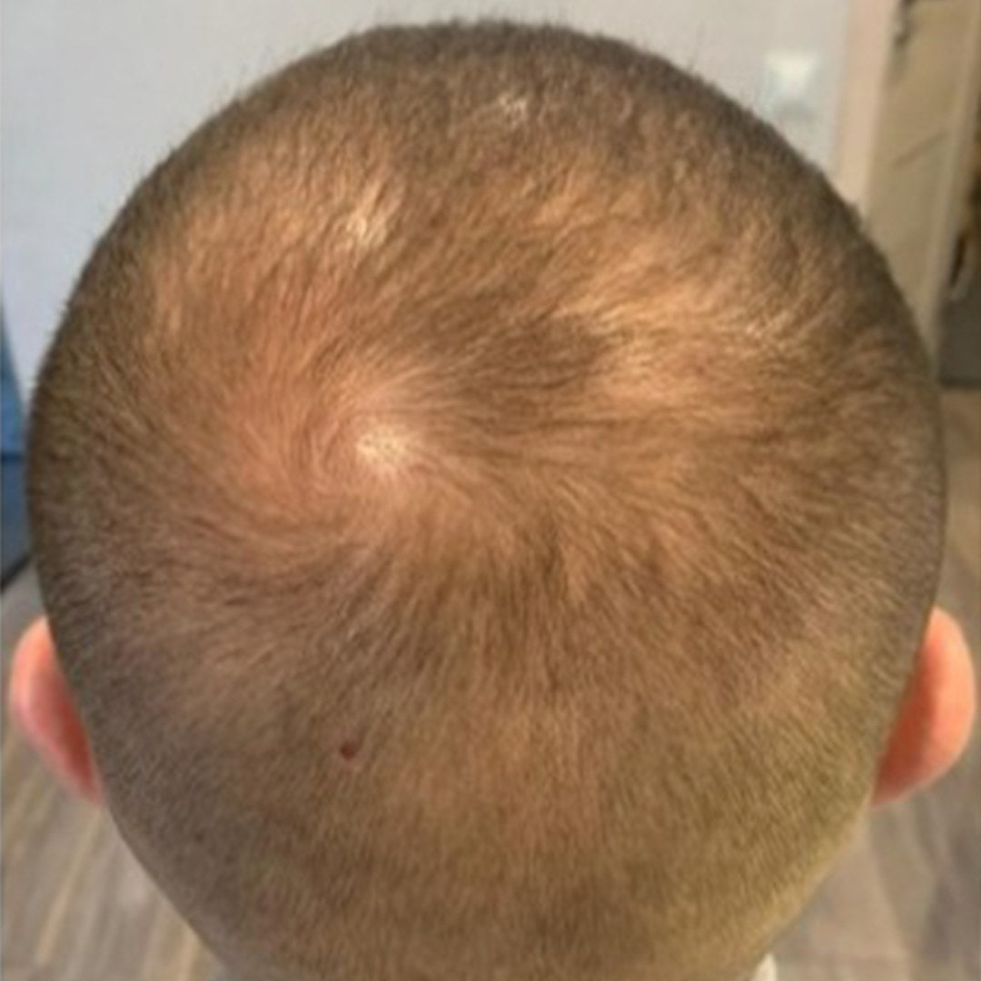 Crown of the same male scalp after six months of nightly DEKOHAIR use