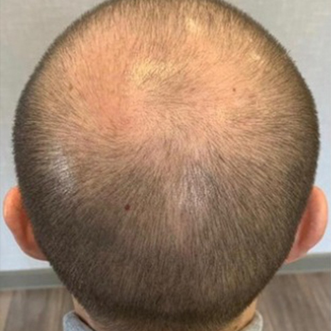 Crown of a male scalp before DEKOHAIR use