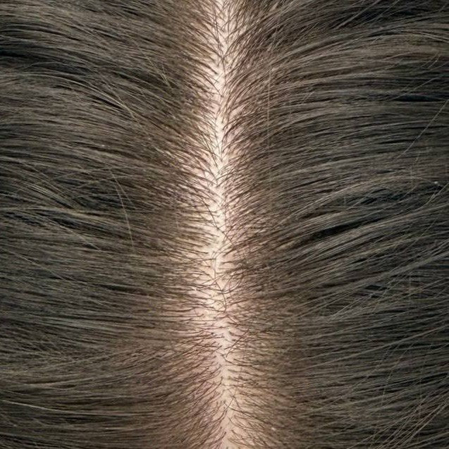 Female part line after consistent nightly DEKOHAIR use