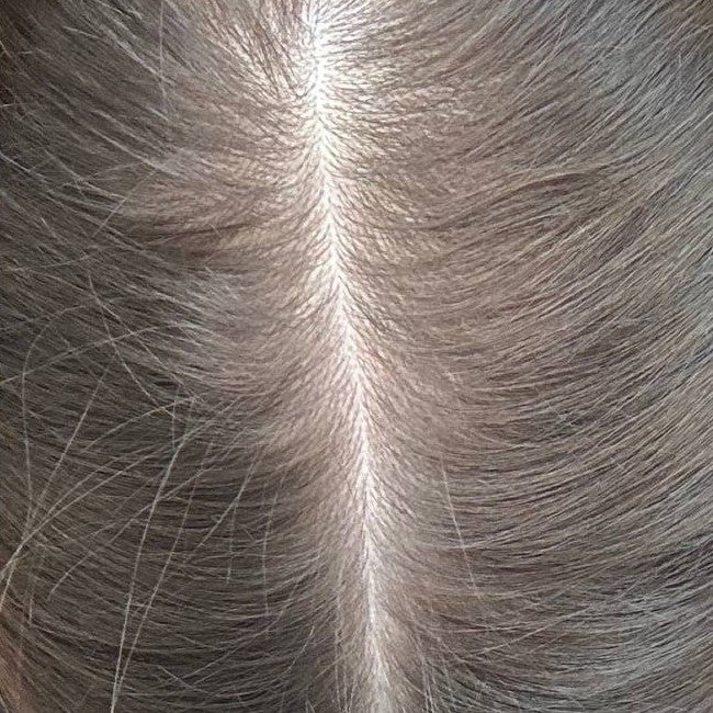 Female crown after consistent nightly DEKOHAIR use