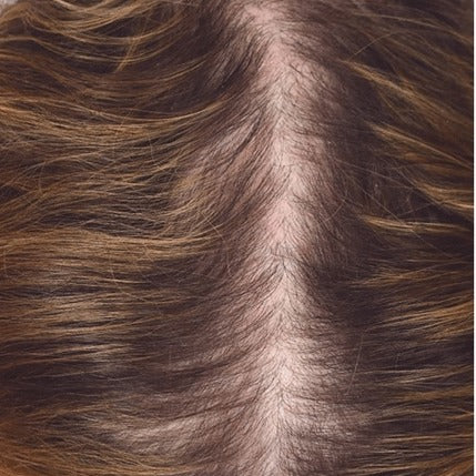Female part line after consistent nightly DEKOHAIR use