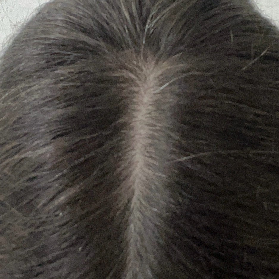 Female part line after consistent nightly DEKOHAIR use