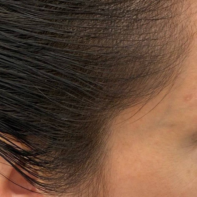 Female temple after consistent nightly DEKOHAIR use