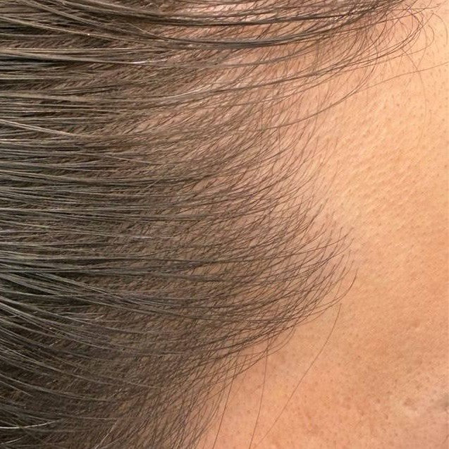 Female hairline after consistent nightly DEKOHAIR use