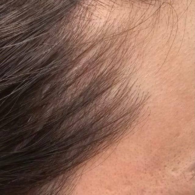 Female hairline before DEKOHAIR use