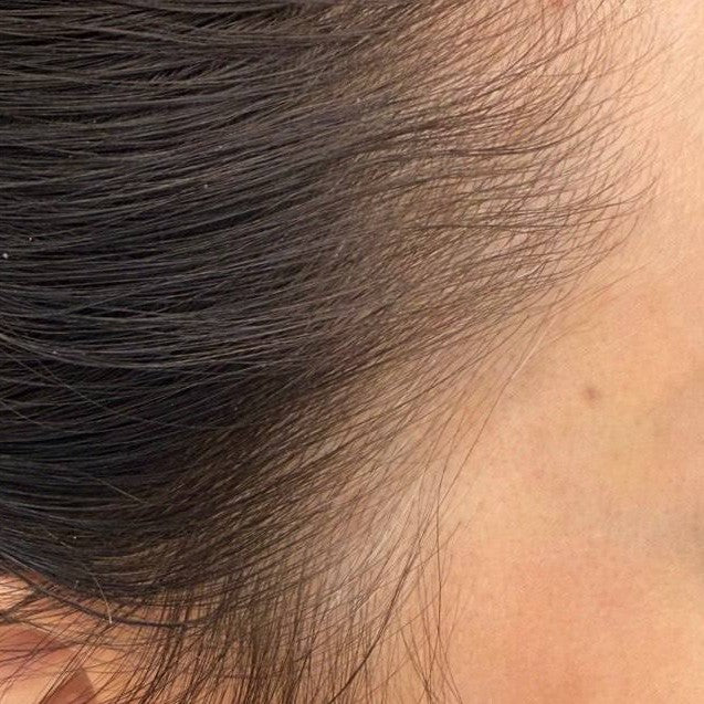 Female temple after consistent nightly DEKOHAIR use