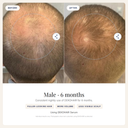 DEKOHAIR 6-Month Bundle