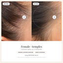 DEKOHAIR 6-Month Bundle